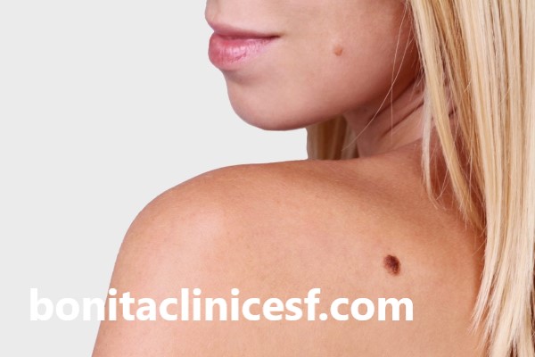 خال شایع ترین ضایعه پوستی | کلینیک بنیتا اصفهان