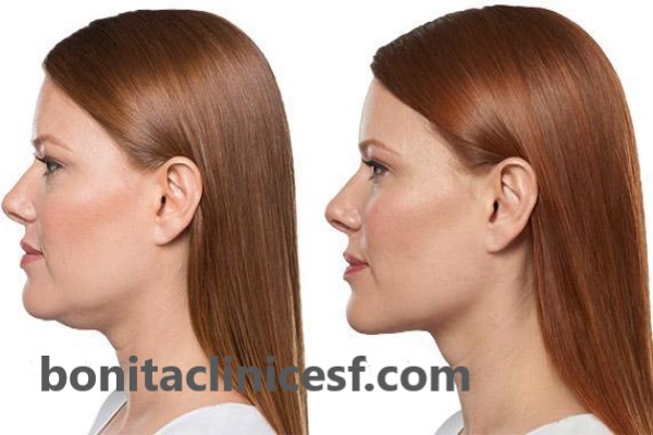 بهترین دکتر برای رفع غبغب اصفهان | کلینیک بنیتا اصفهان