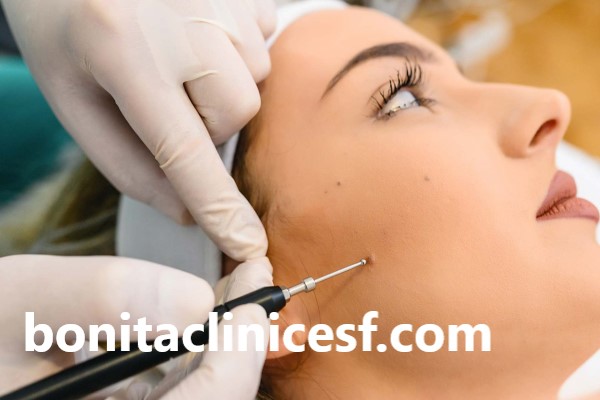 دکتر خوب برای برداشتن خال صورت اصفهان | کلینیک بنیتا اصفهان