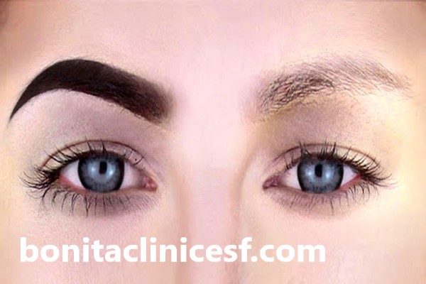 هزينه پاک كردن تاتو ابرو با ليزر در اصفهان چقدر است؟ | کلینیک بنیتا اصفهان