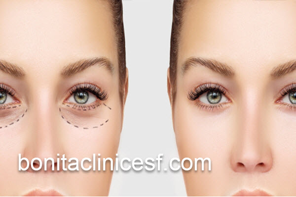 جوان تر شدن با جراحی بلفاروپلاستی پلک پایین | کلینیک بنیتا اصفهان