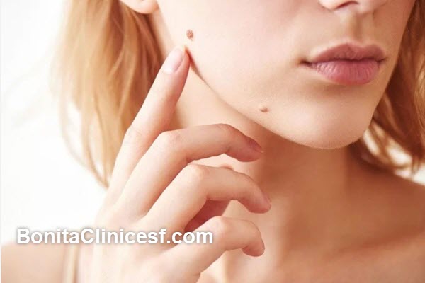خصوصیات مهم برای انتخاب بهترین کلینیک برداشتن خال و زگیل در اصفهان | کلینیک بنیتا اصفهان