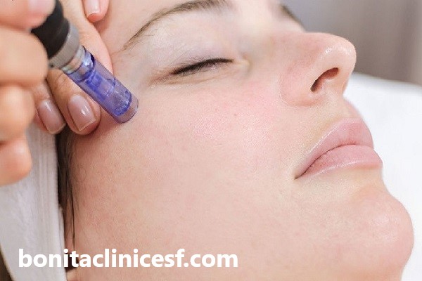 درمان جای جوش و آکنه با رادیوفرکانس | کلینیک بنیتا اصفهان