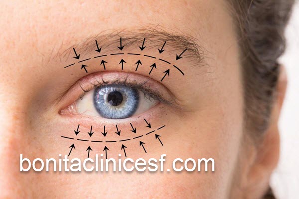 جوانسازی پوست با عمل بلفاروپلاستی | کلینیک بنیتا اصفهان