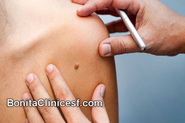 بهترین کلینیک برداشتن خال و زگیل در اصفهان | کلینیک بنیتا اصفهان