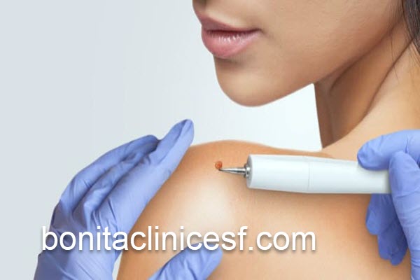 خال برداری با بهترین قیمت در کلینیک تخصصی | کلینیک بنیتا اصفهان