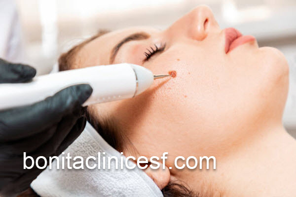 ارائه خدمات خال برداری با بهترین قیمت | کلینیک بنیتا اصفهان