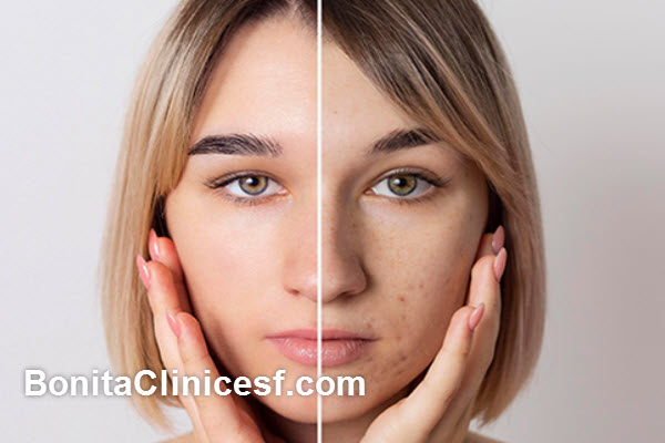 روش های درمان اسکارهای پوستی | کلینیک بنیتا اصفهان