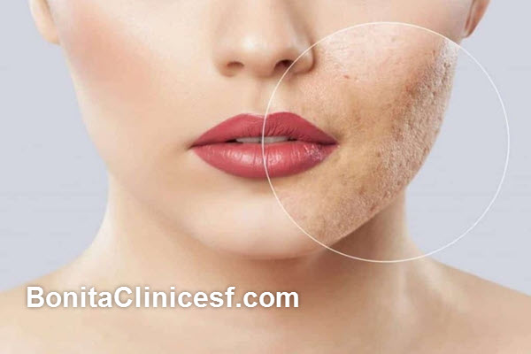 ویژگی های بهترین کلینیک برداشتن اسکارهای پوستی در اصفهان | کلینیک بنیتا اصفهان