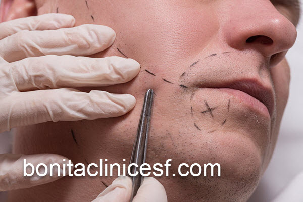 کاشت ریش و سبیل در مرکز تخصصی | کلینیک بنیتا اصفهان