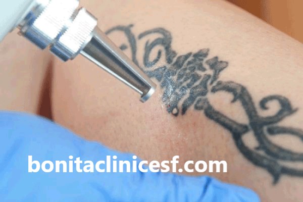 کاربرد های لیزر کیوسوئیچ | کلینیک بنیتا اصفهان