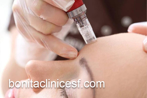 مزوتراپی صورت با قیمت مناسب در اصفهان | کلینیک بنیتا اصفهان