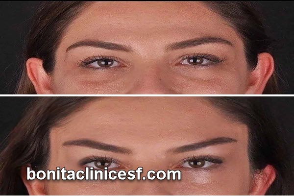 مراقبت های بعد از عمل لیفت شقیقه و پیشانی | کلینیک بنیتا