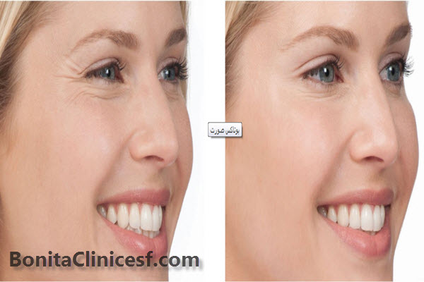 استفاده از بوتاکس باکیفیت