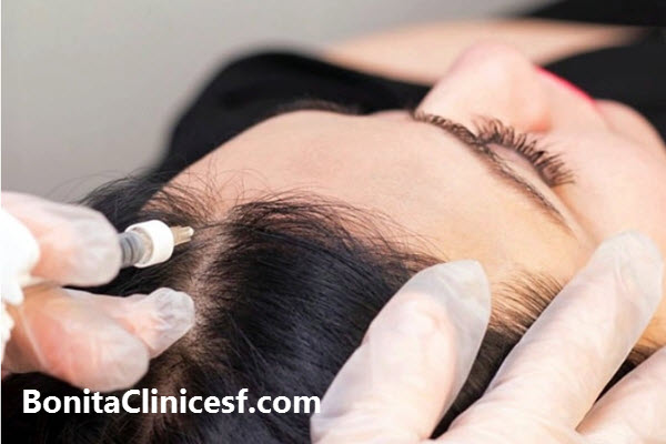 منظور از فیلر مو چیست؟