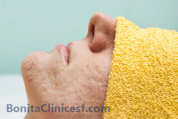 بهترین درمان اسکار صورت در اصفهان