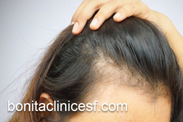 کاهش ریزش مو با روش فوتونا | کلینیک بنیتا اصفهان