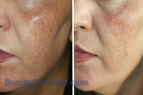 مراقبت های بعد از مزوتراپی