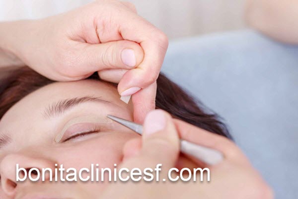 قیمت عمل بلفاروپلاستی در اصفهان | کلینیک بنیتا اصفهان