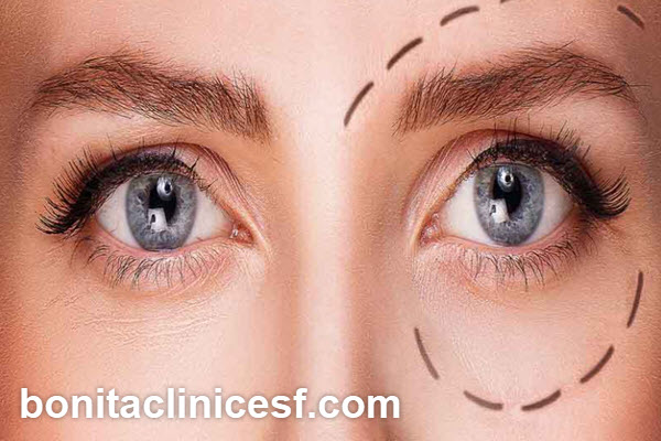 بلفاروپلاستی چیست؟ | کلینیک بنیتا اصفهان