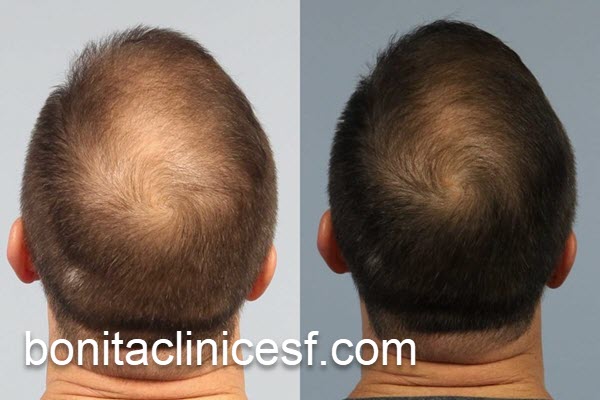 بهترین روش برای درمان ریزش مو | کلینیک بنیتا اصفهان