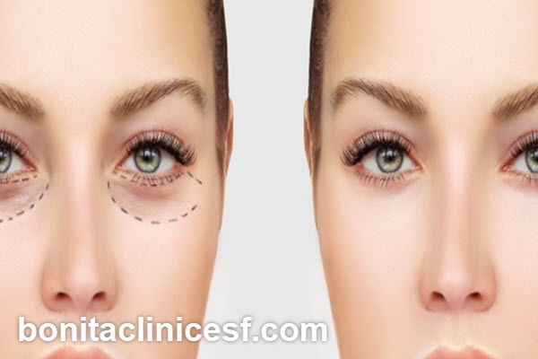 چشمهای جوانتر با بلفاروپلاستی در اصفهان | کلینیک بنیتا