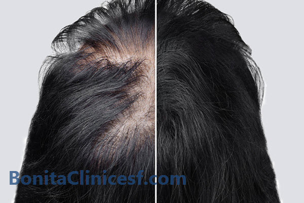 تقویت و درمان ریزش مو در بهترین کلینیک اصفهان