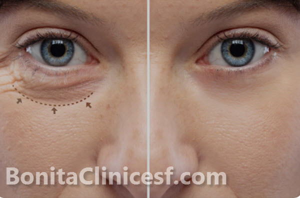 بلفاروپلاستی چیست؟ | استان اصفهان