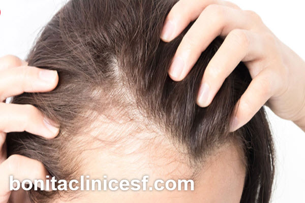 بهترین روش کاشت مو در اصفهان کدام است؟ | کلینیک بنیتا اصفهان