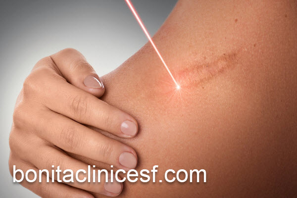 برترین مرکز درمان اسکار پوستی | کلینیک بنیتا اصفهان