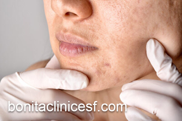 از بین بردن اسکارهای پوستی در اصفهان | کلینیک بنیتا اصفهان