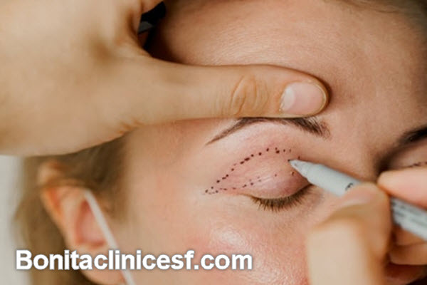 انجام عمل افتادگی پلک در اصفهان | کلینیک بنیتا