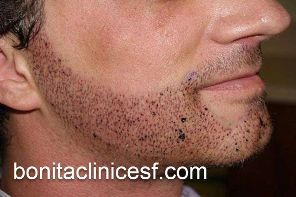 بررسی قیمت کاشت ریش در سال 1403 در اصفهان | کلینیک بنیتا اصفهان