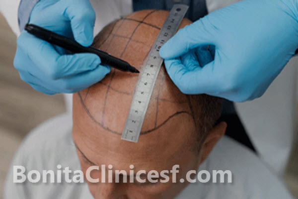 کاشت مو به روش میکروگرافت چیست؟