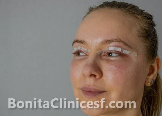 کاندید های نامناسب برای انجام عمل بلفاروپلاستی