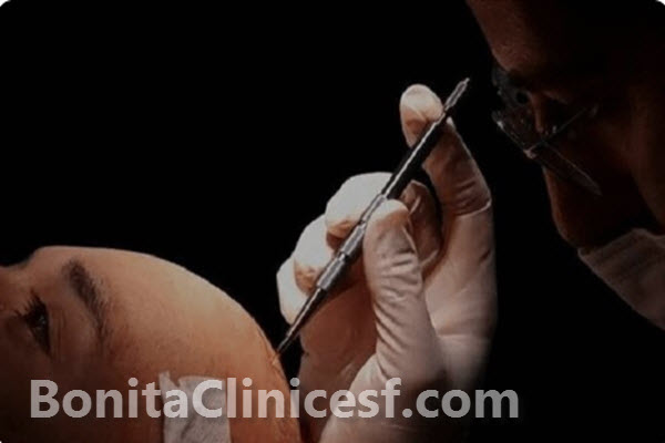 قیمت کاشت مو به روش میکروگرافت چقدر است؟