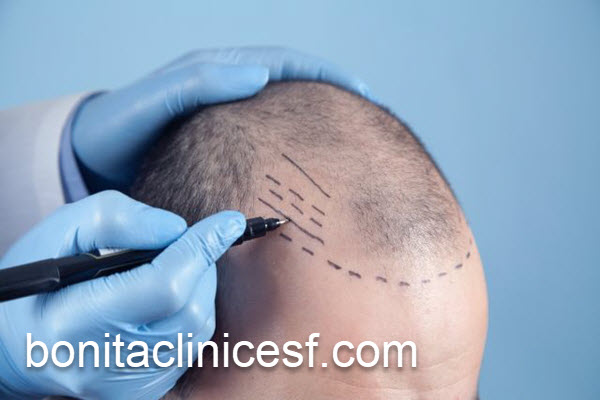 برترین مرکز کاشت مو در اصفهان | کلینیک بنیتا اصفهان