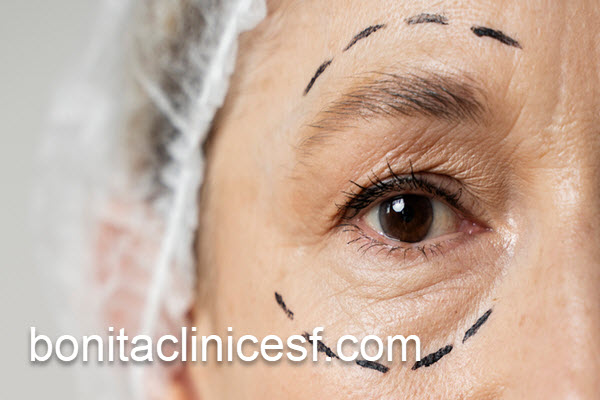 بلفاروپلاستی پلک در بهترین کلینیک زیبایی | کلینیک بنیتا اصفهان