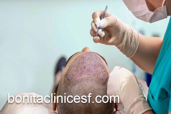 کاشت مو با بهترین روش در اصفهان | کلینیک بنیتا اصفهان