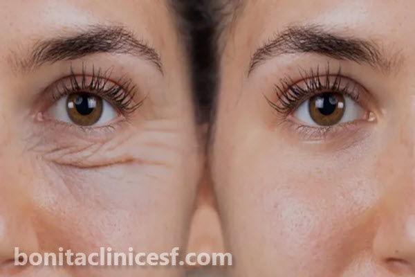 بلفاروپلاستی چیست؟ | کلینیک بنیتا