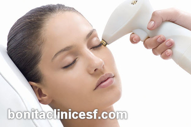 هزینه لیزر آر اف صورت | کلینیک بنیتا اصفهان