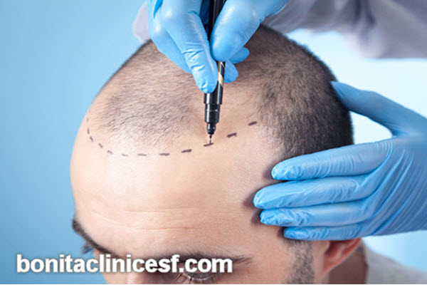 عوامل موثر بر قیمت کاشت مو طبیعی | کلینیک بنیتا اصفهان