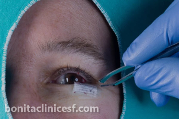 قیمت جراحی پلک پایین در اصفهان