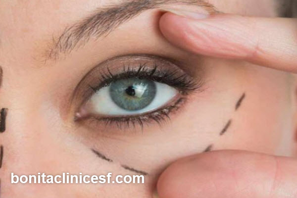 رعایت مراقبت های بعد عمل پلک افتاده | کلینیک بنیتا اصفهان