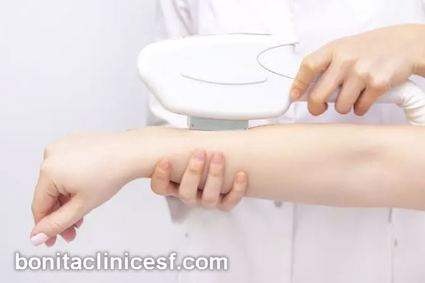 تعداد جلسات لیزر موهای زائد چقدر است؟ | کلینیک بنیتا اصفهان