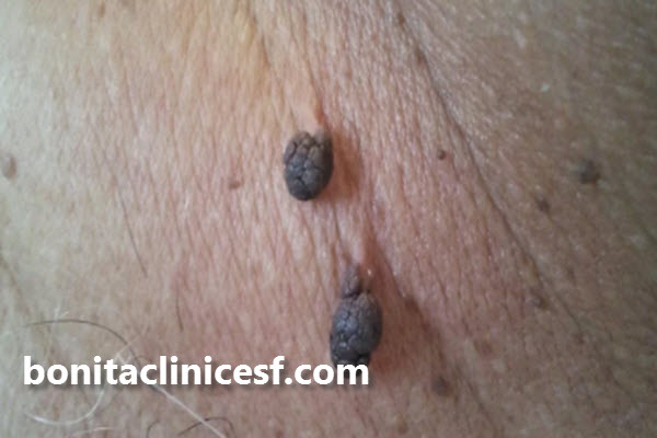 تشخیص خال گوشتی چگونه است؟