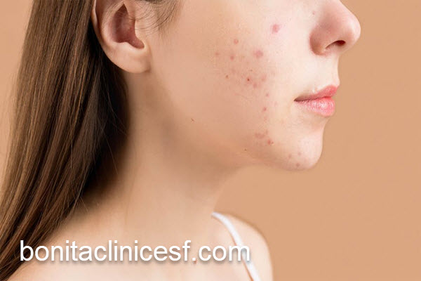 بهترین مرکز درمان اسکار فرورفته با لیزر در اصفهان | کلینیک بنیتا اصفهان