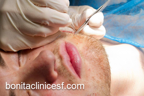 محافطت از پوست و مو پس از کاشت ریش | کلینیک بنیتا اصفهان