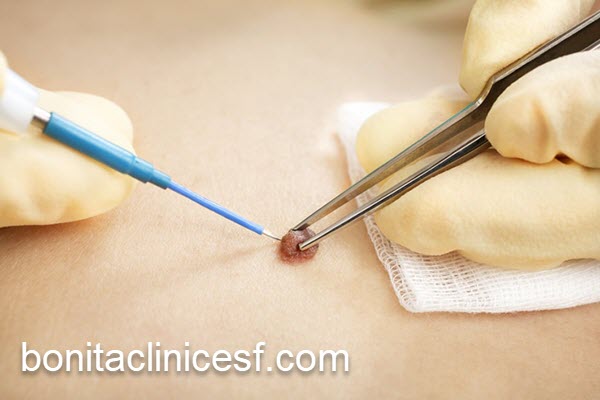 هزینه خدمات برداشتن خال و زگیل | کلینیک بنیتا اصفهان