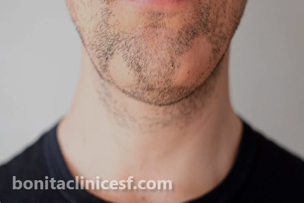 کاشت ریش چیست؟